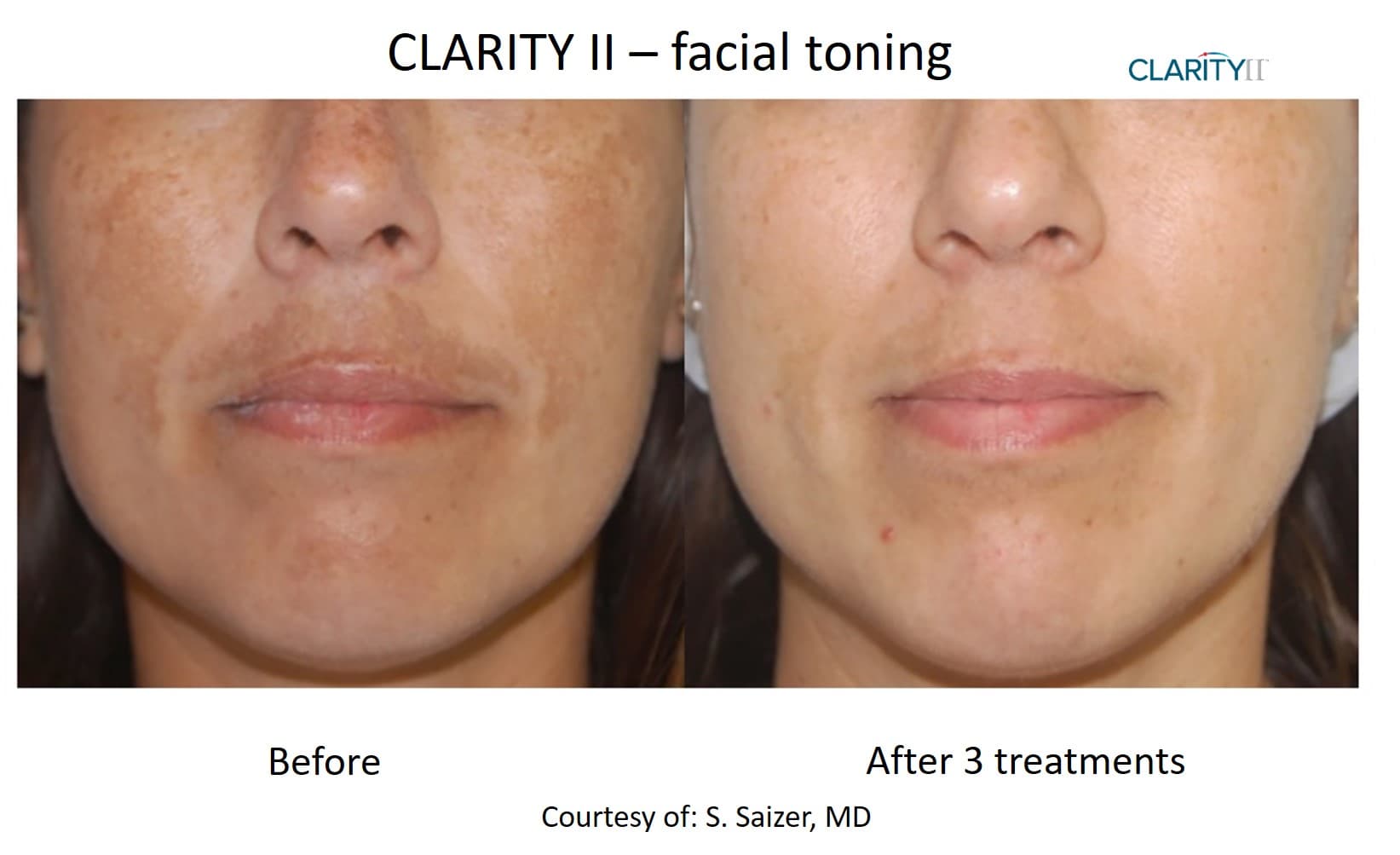 Before and after skin pigmentation & sun damage - Patient SP-000