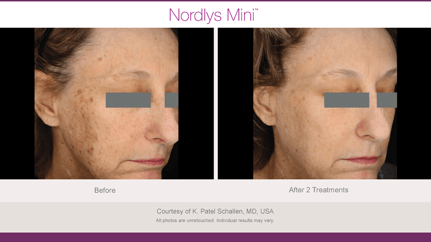 Before and after skin pigmentation & sun damage - Patient SP-001