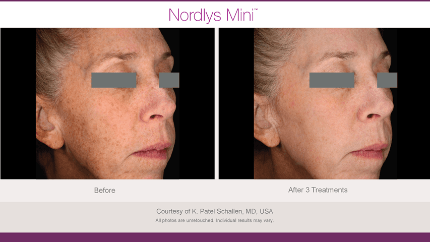 Before and after skin pigmentation & sun damage - Patient SP-002
