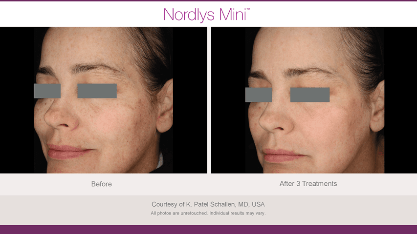 Before and after skin pigmentation & sun damage - Patient SP-004