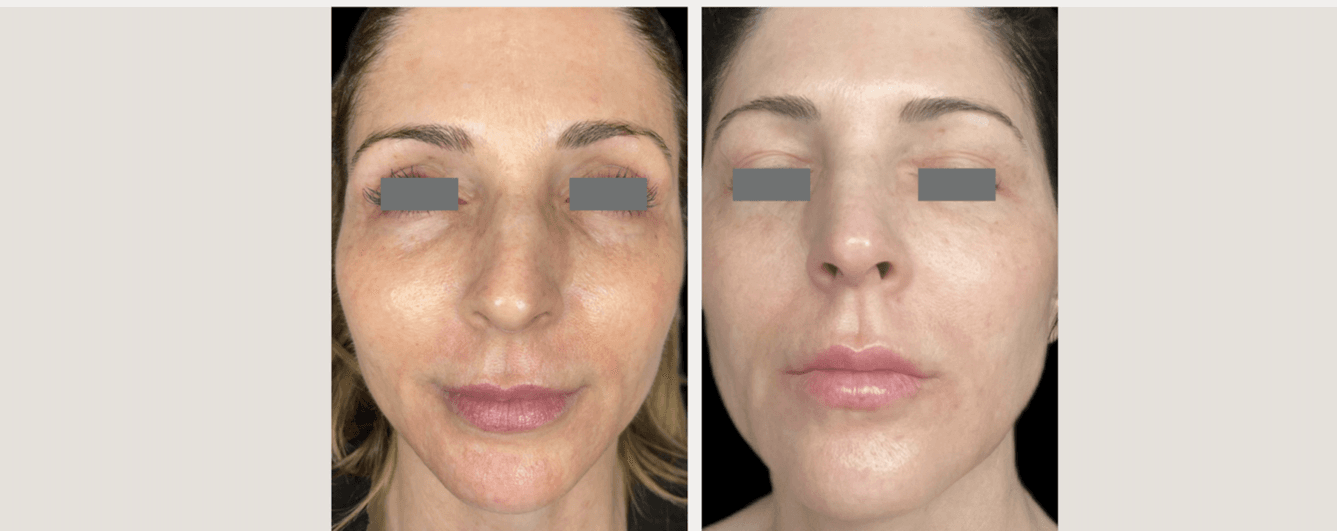 Before and after skin rejuvenation & tightening - Patient ST-002