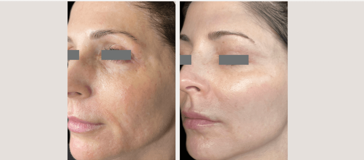 Before and after skin rejuvenation & tightening - Patient ST-003