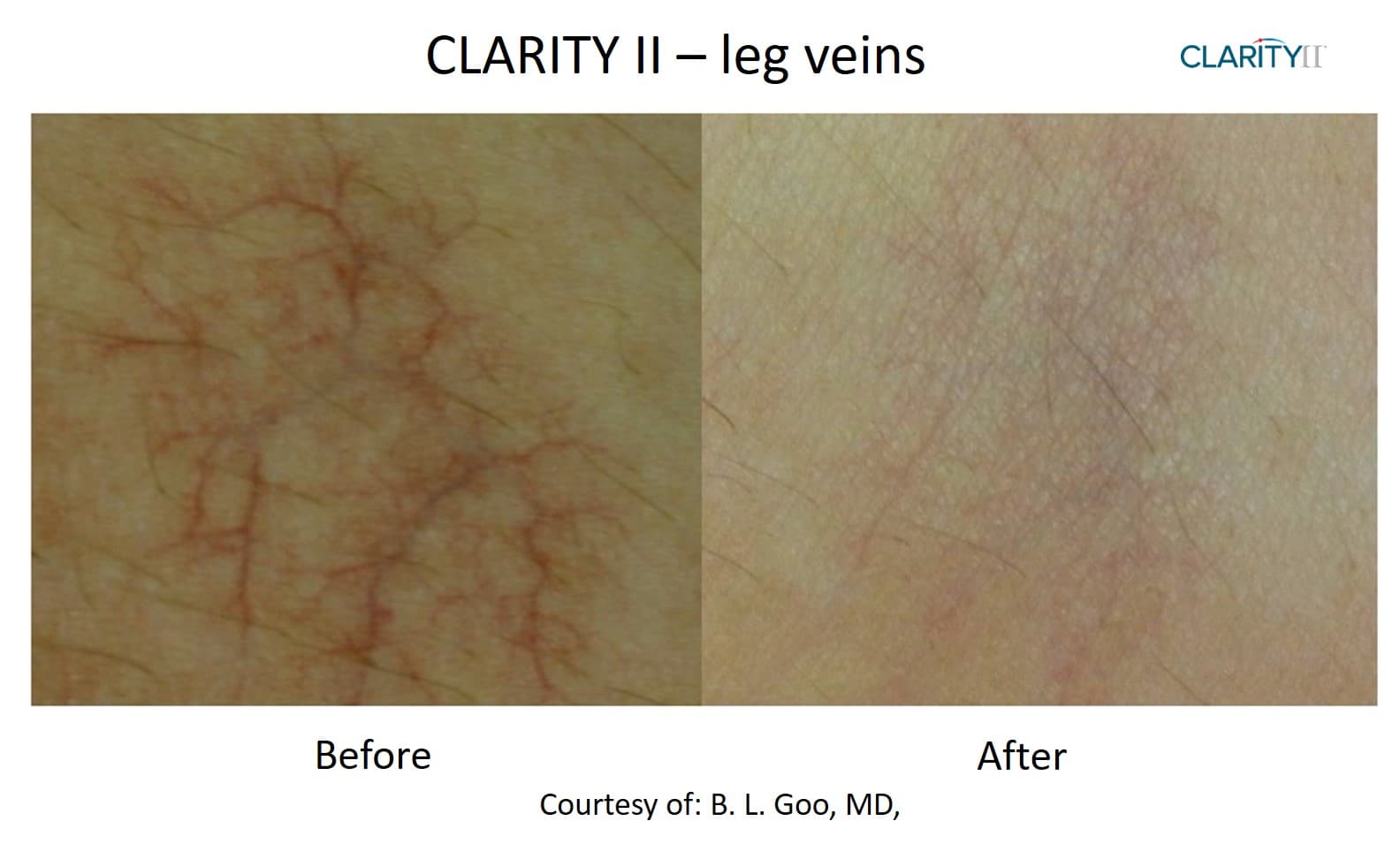 Before and after vascular lesions & broken vessels - Patient VL-001