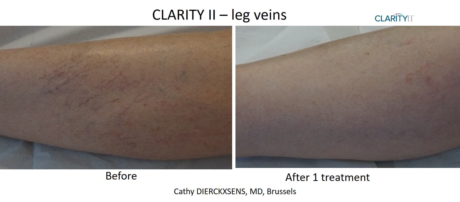 Before and after vascular lesions & broken vessels - Patient VL-002