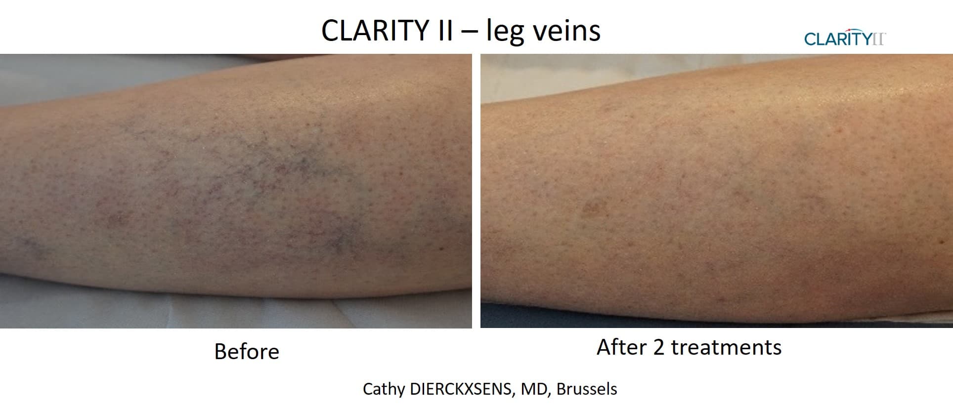 Before and after vascular lesions & broken vessels - Patient VL-003