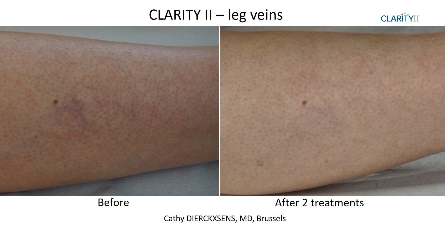Before and after vascular lesions & broken vessels - Patient VL-004