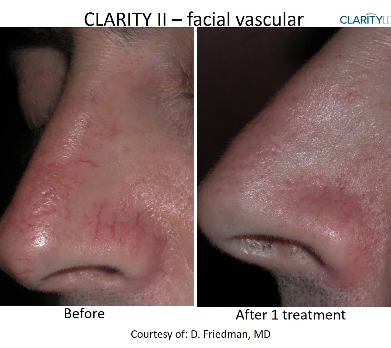 Before and after vascular lesions & broken vessels - Patient VL-005