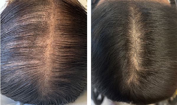 Before and after kerafactor hair restoration - Patient undefined