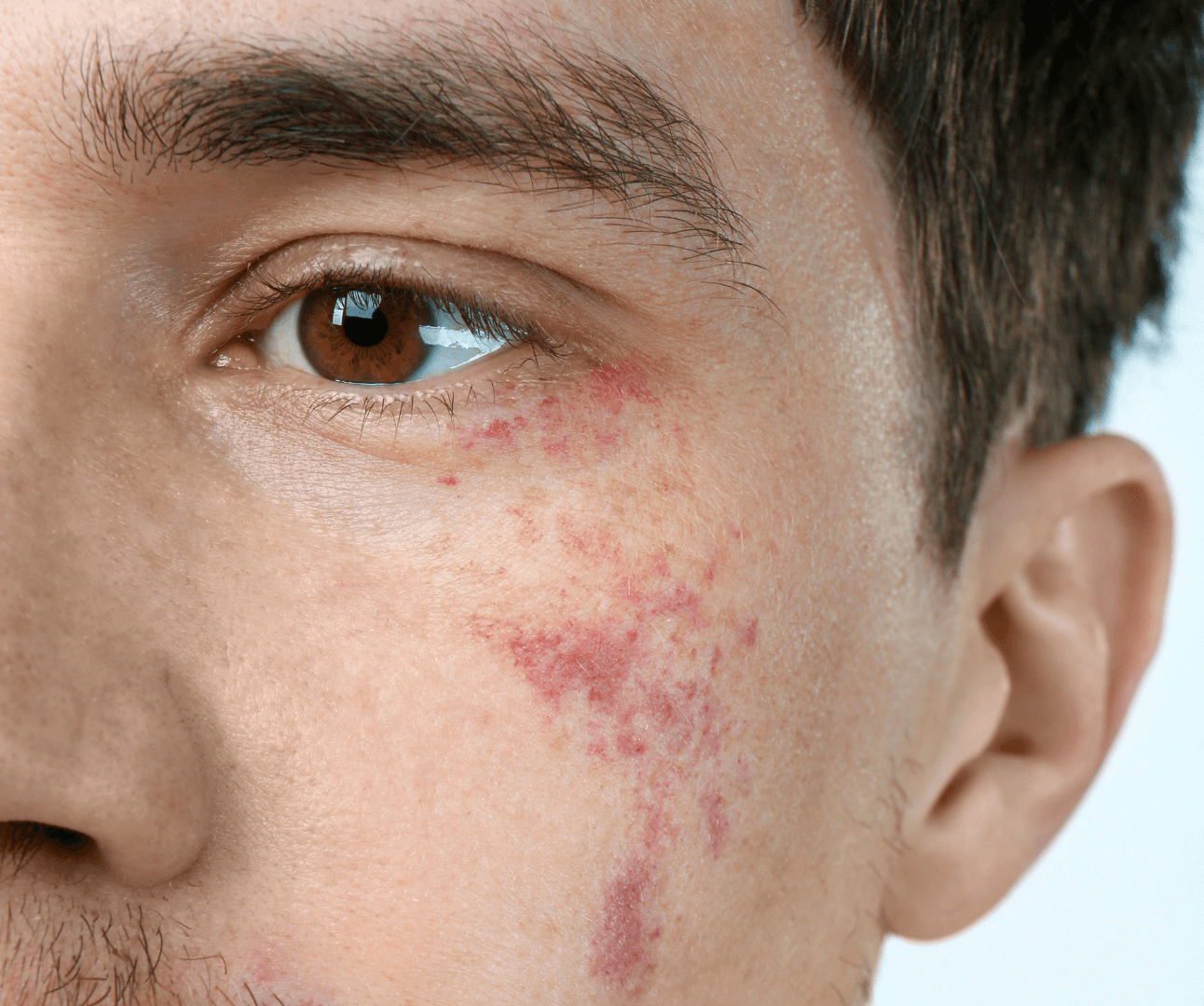 Vascular Birthmarks & Café-au-Lait Spots