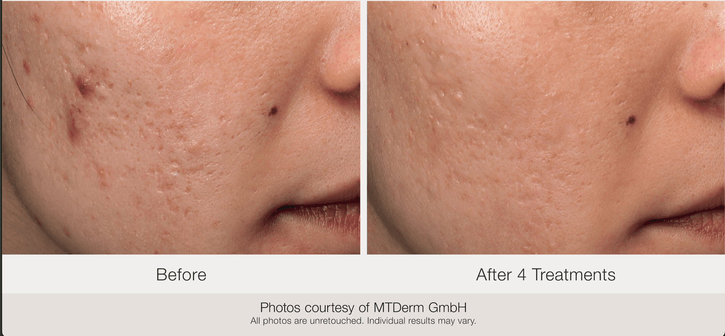 Before and after laser acne scar treatment - Patient AS-001