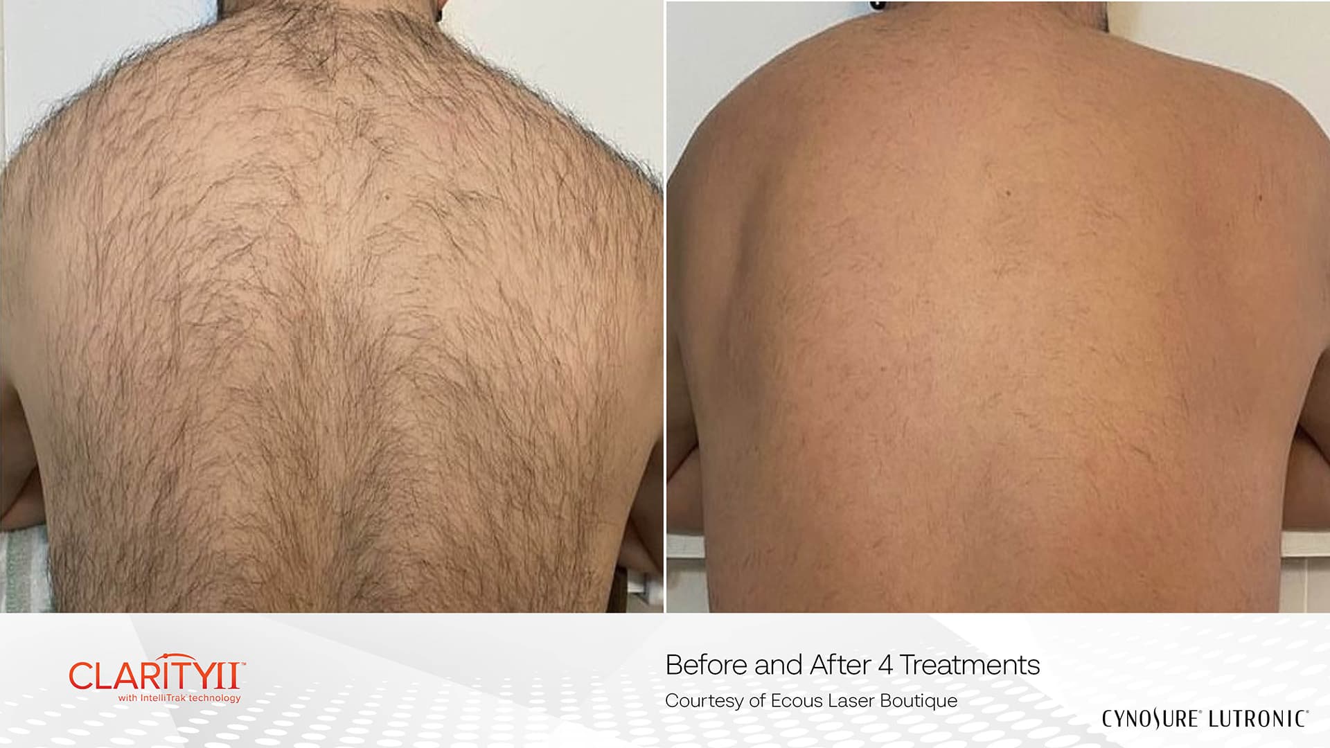 Before and after laser hair removal - Patient HR-001