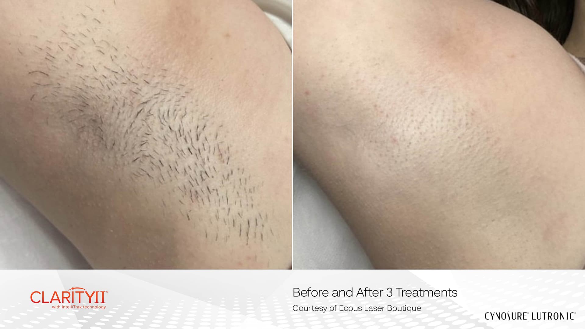 Before and after laser hair removal - Patient HR-002