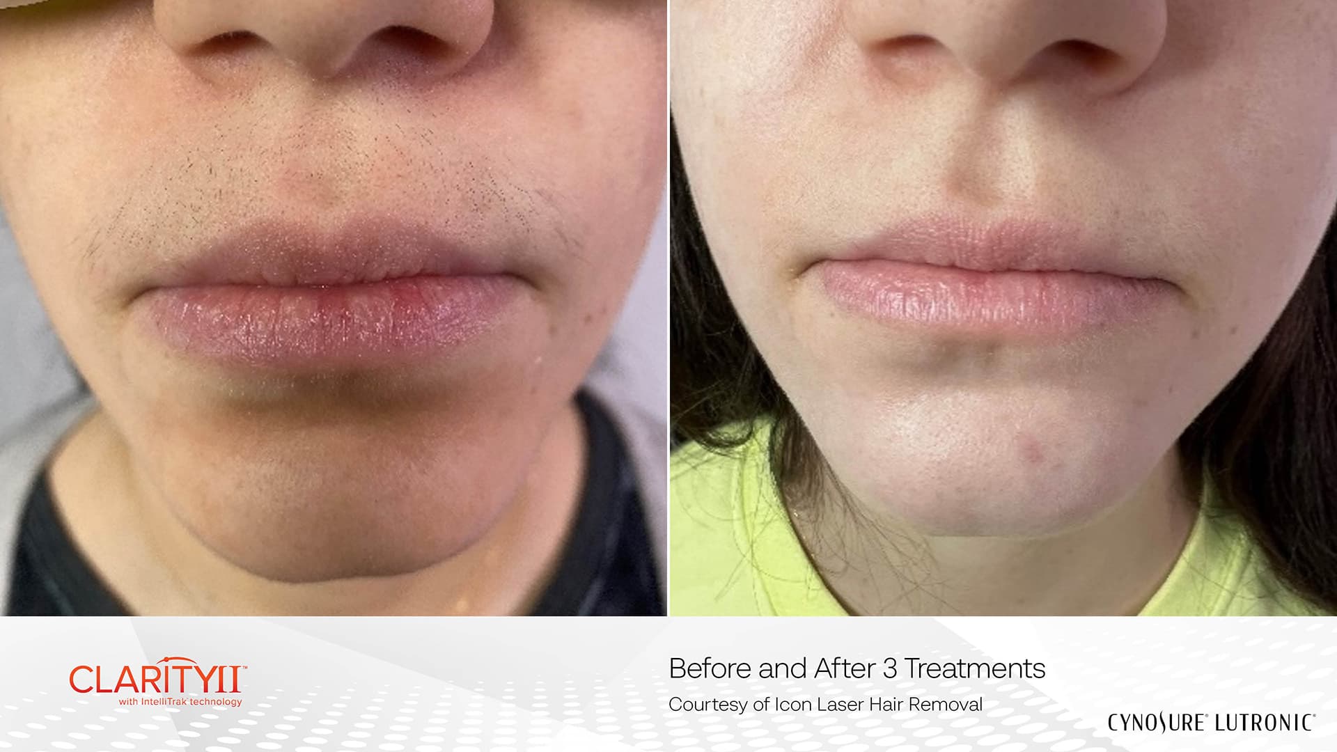 Before and after laser hair removal - Patient HR-003