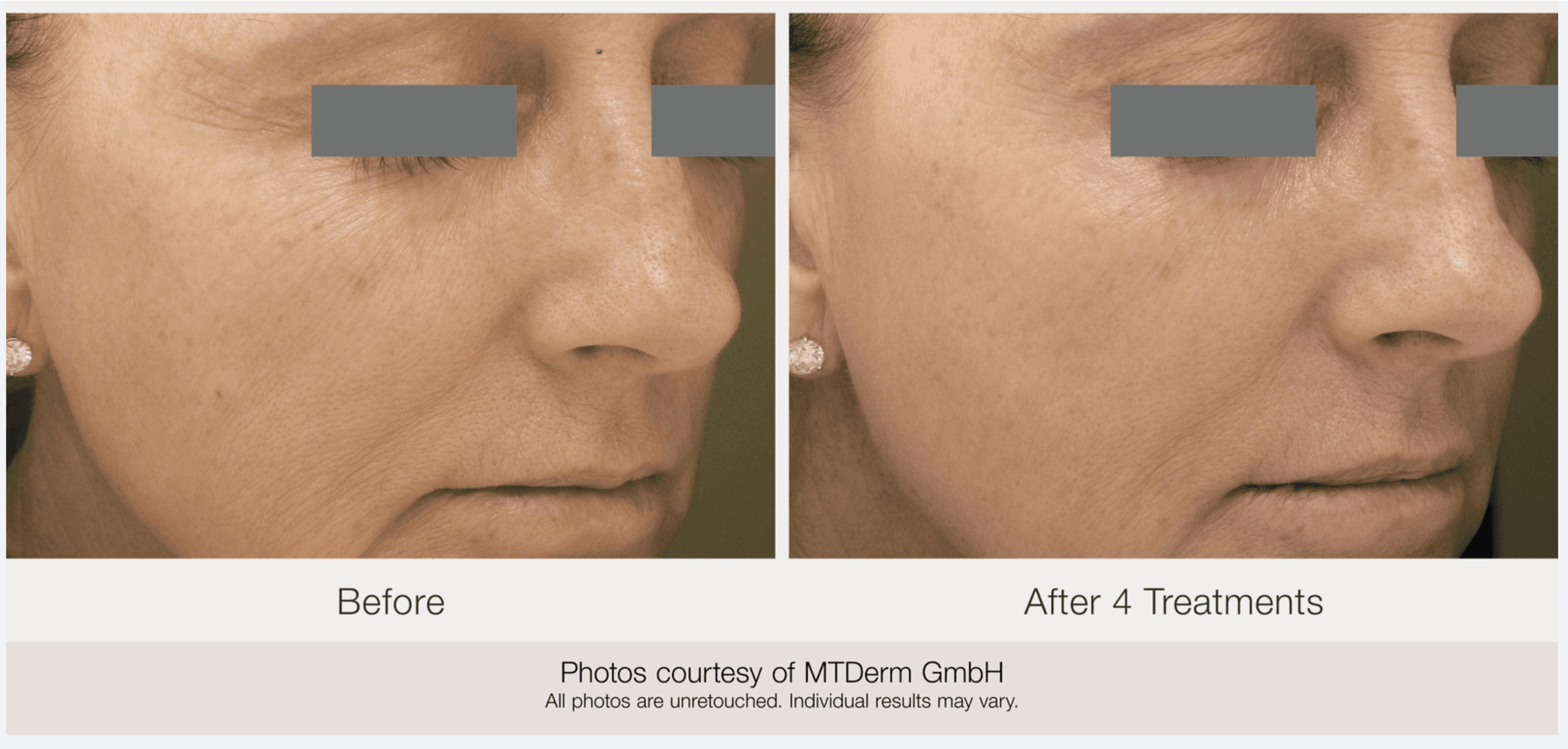 Before and after skin rejuvenation & resurfacing - Patient SR-001