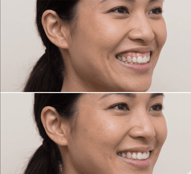 Gummy Smile