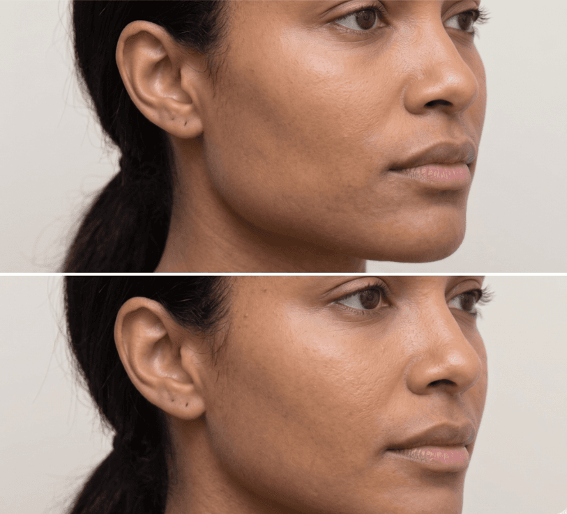 Jawline Slimming
