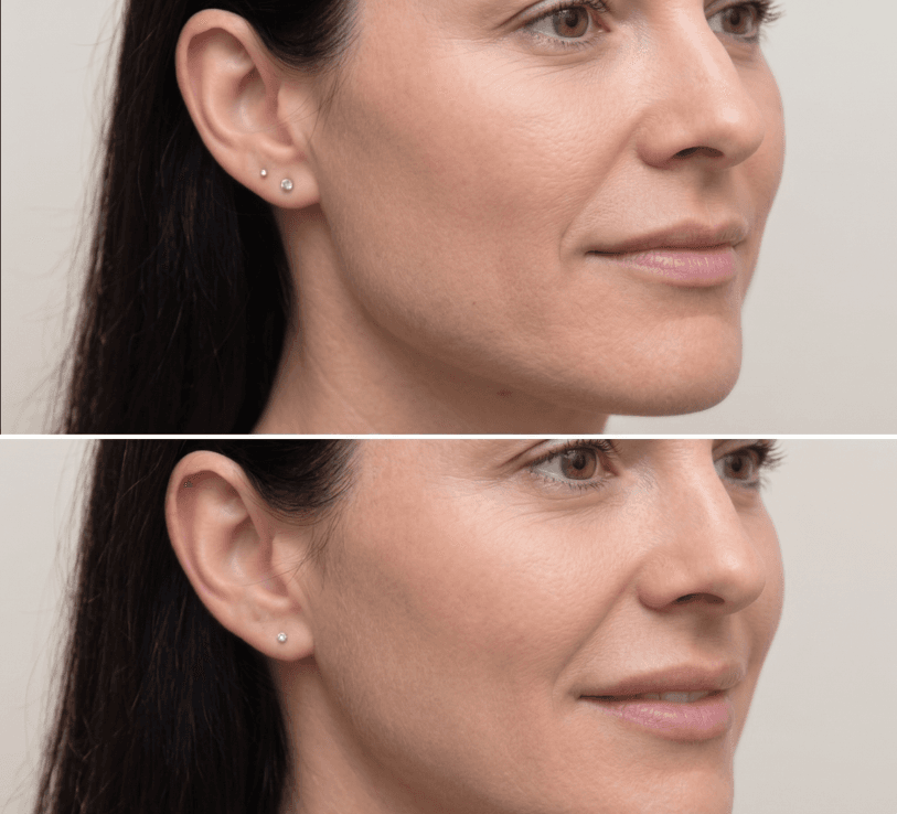 Injectables treatment at Pure MedSpa in Woodinville