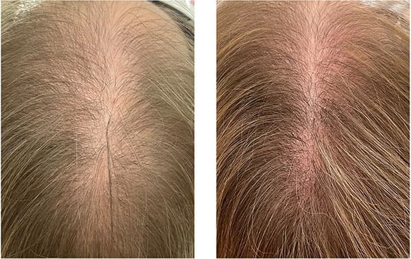 Before and after kerafactor hair restoration - Patient undefined