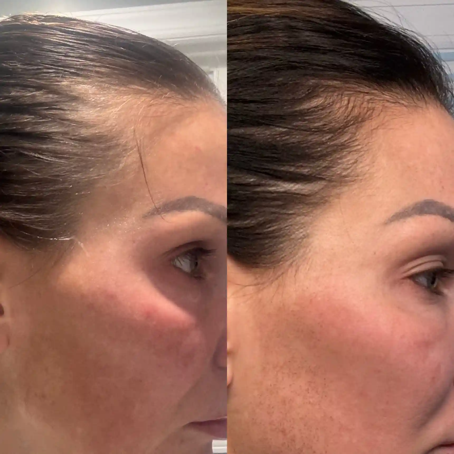 Laser Hair Restoration