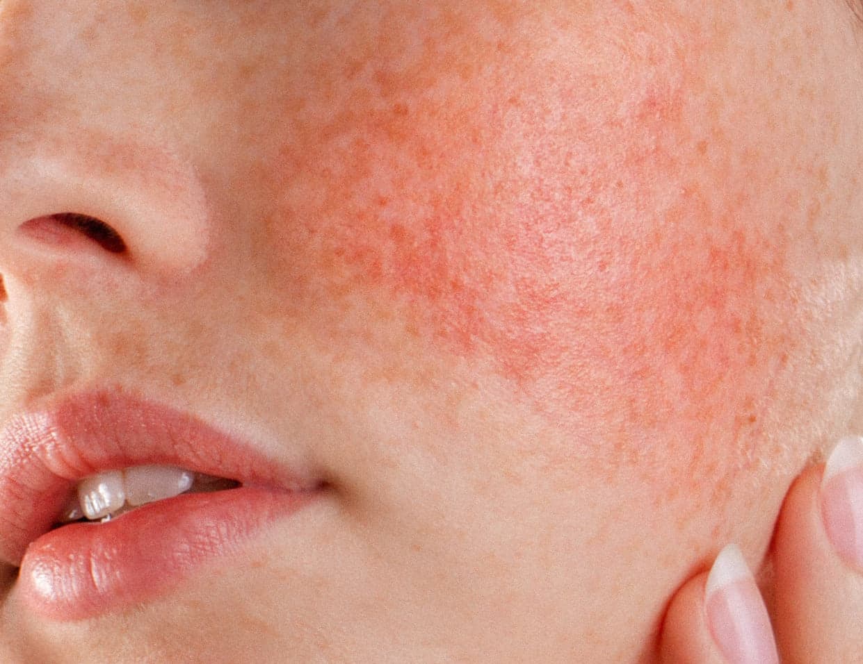 Rosacea & Redness Reduction
