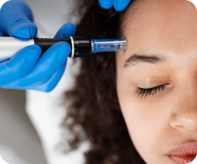 Microneedling treatment at Pure MedSpa in Woodinville