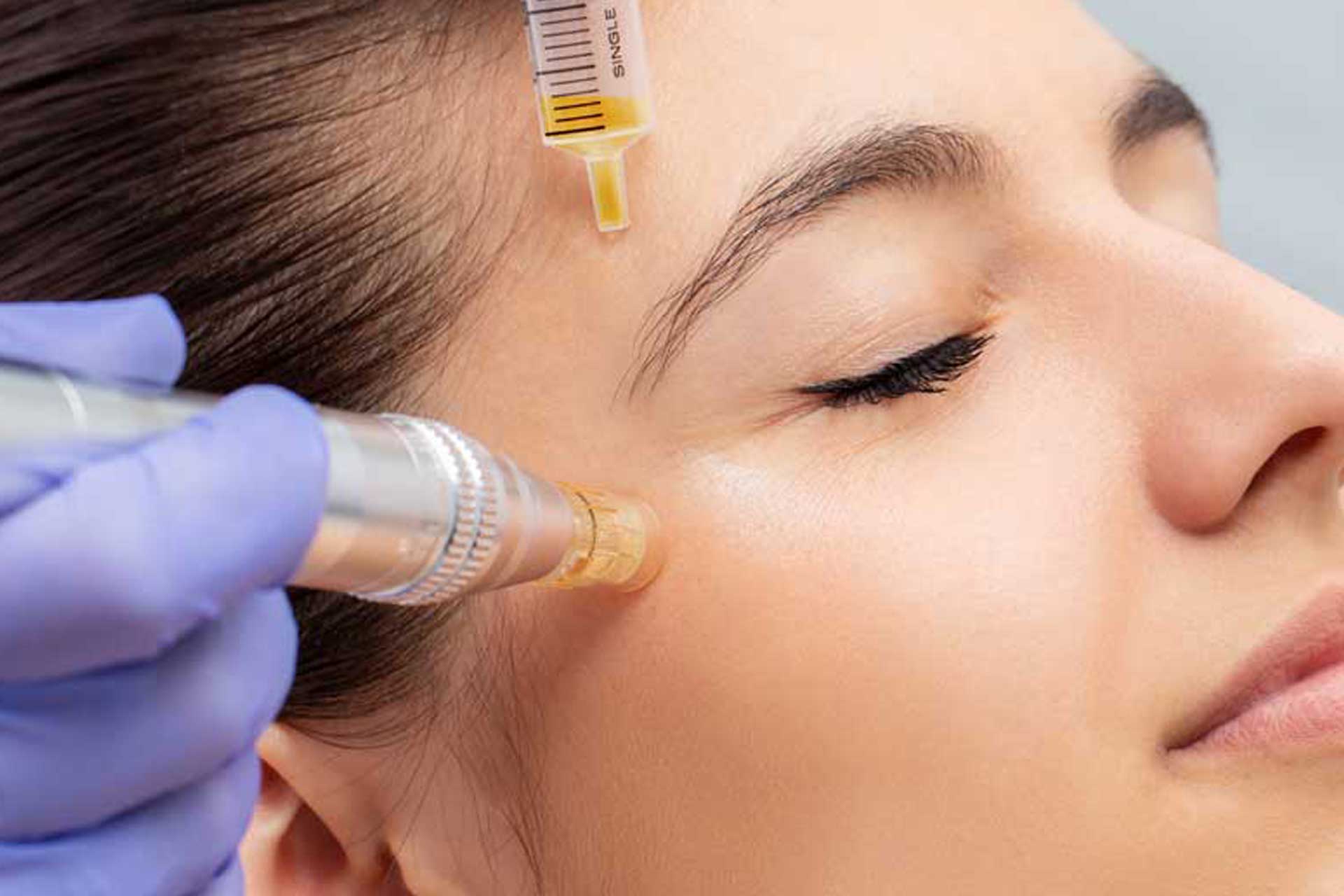 Microneedling